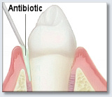 Periodontal Disease Treatment Antibiotics